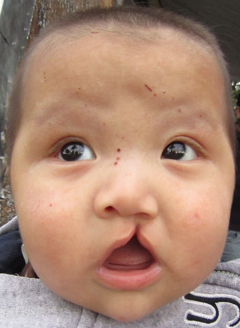 Cleft lip and palate poto by James Heilman, MD - Own work Creative Commons