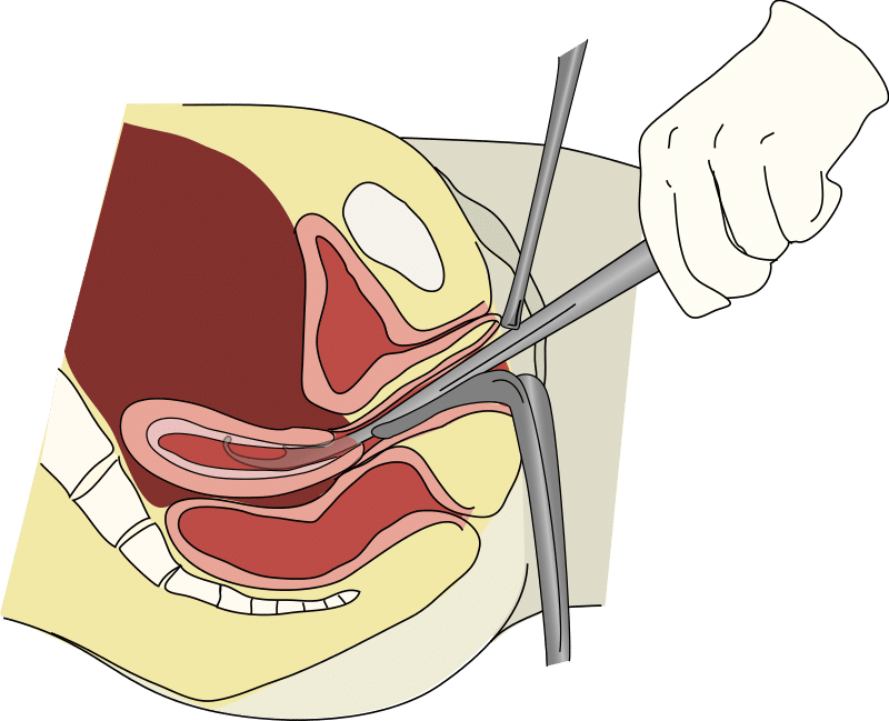 By Vacuum-aspiration_(single).svg: Andrew cDilation_and_curettage.svg: Fred the Oysterderivative work: Andrew c (talk) - Vacuum-aspiration_(single).svgDilation_and_curettage.svg, CC BY-SA 3.0