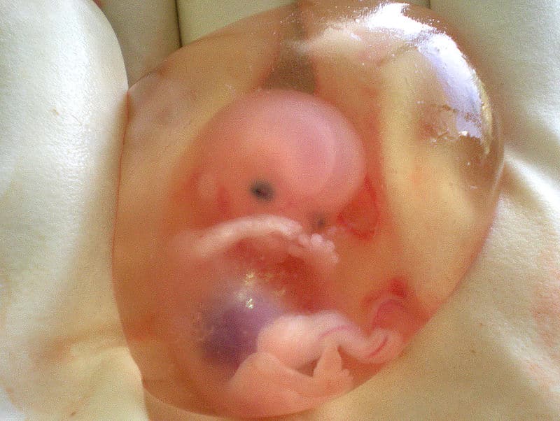 Human fetus 10 weeks with amniotic sac Photo by Dr Suparna Wikipedia CC