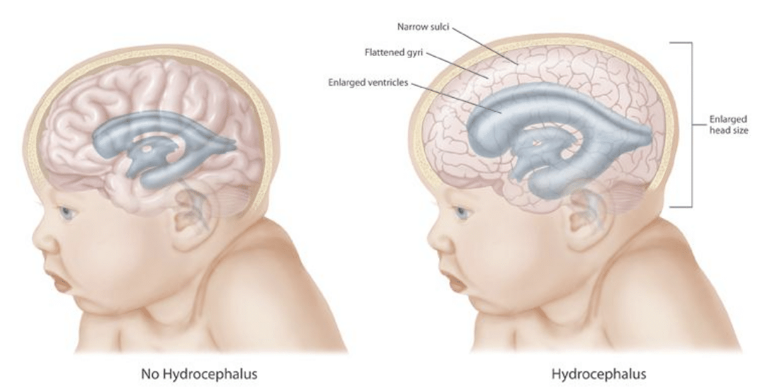 Illustration showing effects of hydrocephalus on the brain and cranium. CDC Public Domain
