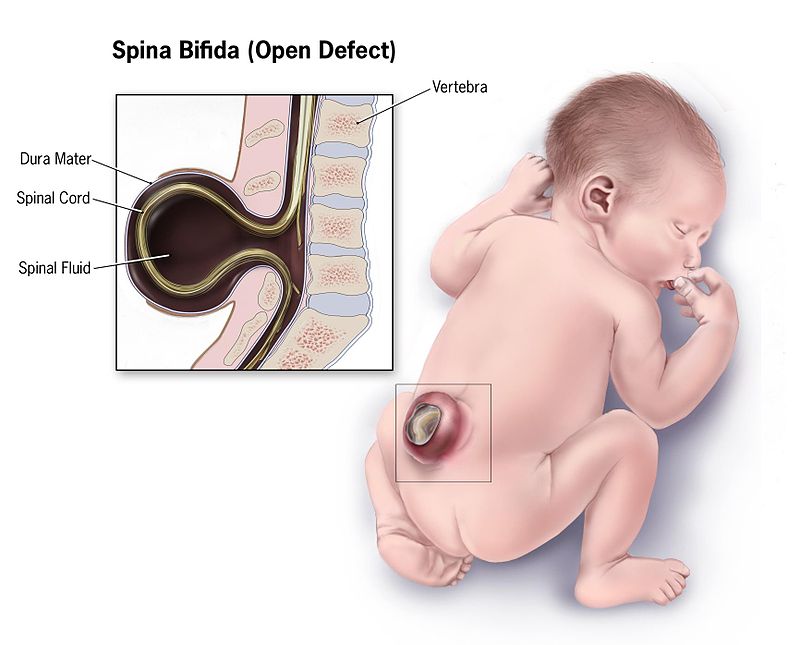 An illustration of an infant with Spina Bifida CDC- Public Domain 