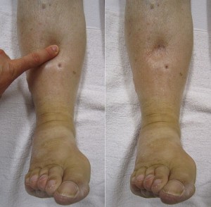 A photograph showing pitting edema