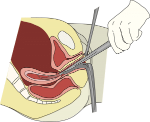 A medical illustration of Dilation and curettage (D&C) is a procedure to remove tissue from inside the uterus.