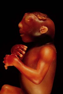 a photo of a baby with Anencephaly