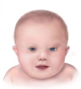 medical illustration of classical down syndrome features