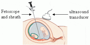 medical illustration of a fetoscopy