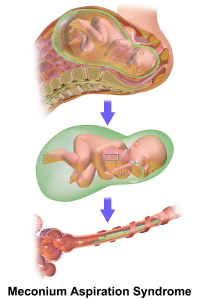 A #D rendering depicting Meconium Aspiration Syndrome
