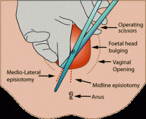 medical diagram showing the procedure of an Episiotomy