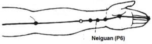 A shiatsu massage diagram showing the Neiguan Pressure point P6 which is beleived to help with management of labor pain