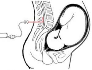 A diagram showing where the epidural is inserted